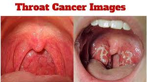 Get Hpv Symptoms Throat Pictures Gif